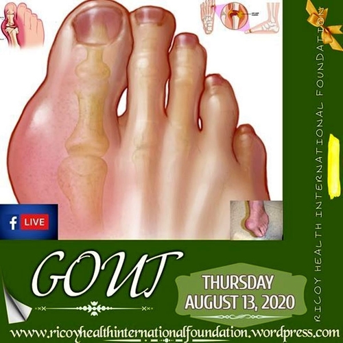 DISCUSSION ON THE TOPIC: "GOUT"